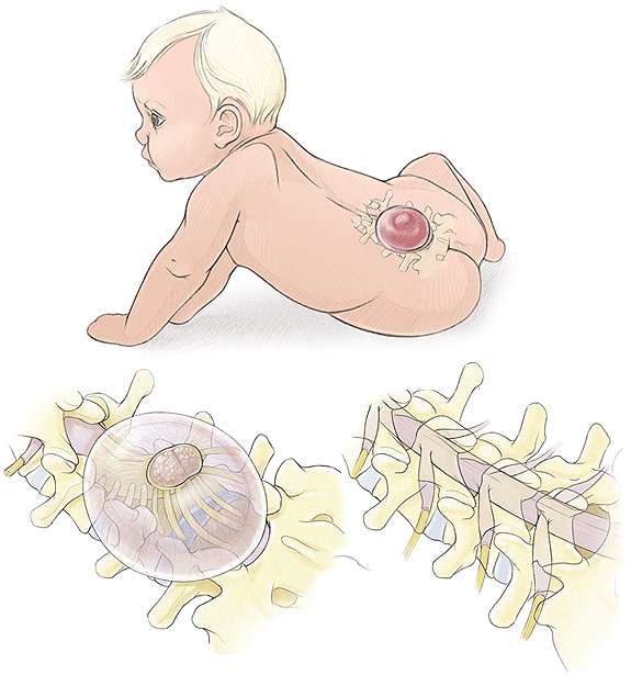 spina-bifida-bebe
